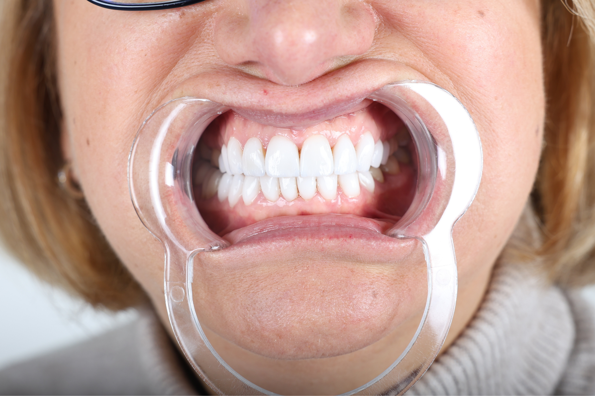 After E-max Veneer Treatment